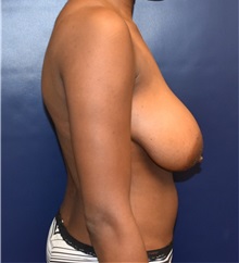 Breast Reduction Before Photo by Richard Reish, MD, FACS; New York, NY - Case 32845