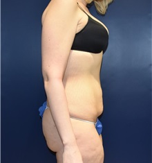 Tummy Tuck Before Photo by Richard Reish, MD, FACS; New York, NY - Case 32848