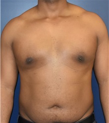 Male Breast Reduction After Photo by Richard Reish, MD, FACS; New York, NY - Case 32850