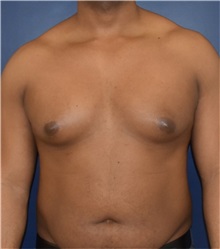 Male Breast Reduction Before Photo by Richard Reish, MD, FACS; New York, NY - Case 32850