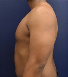 Male Breast Reduction After Photo by Richard Reish, MD, FACS; New York, NY - Case 32850