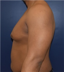 Male Breast Reduction Before Photo by Richard Reish, MD, FACS; New York, NY - Case 32850