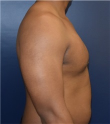Male Breast Reduction After Photo by Richard Reish, MD, FACS; New York, NY - Case 32850