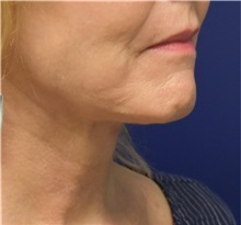 Facelift After Photo by Richard Reish, MD, FACS; New York, NY - Case 32851