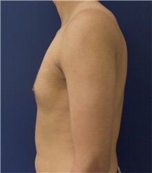 Male Breast Reduction After Photo by Richard Reish, MD, FACS; New York, NY - Case 32875