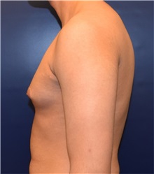 Male Breast Reduction Before Photo by Richard Reish, MD, FACS; New York, NY - Case 32875