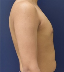 Male Breast Reduction After Photo by Richard Reish, MD, FACS; New York, NY - Case 32875