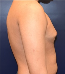Male Breast Reduction Before Photo by Richard Reish, MD, FACS; New York, NY - Case 32875