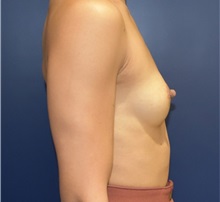 Breast Augmentation Before Photo by Richard Reish, MD, FACS; New York, NY - Case 32876