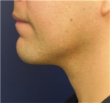Chin Augmentation After Photo by Richard Reish, MD, FACS; New York, NY - Case 32881