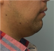 Chin Augmentation Before Photo by Richard Reish, MD, FACS; New York, NY - Case 32881