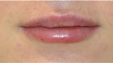 Lip Augmentation / Enhancement After Photo by Richard Reish, MD, FACS; New York, NY - Case 32882