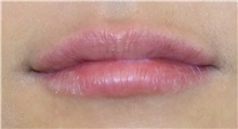 Lip Augmentation / Enhancement After Photo by Richard Reish, MD, FACS; New York, NY - Case 32884