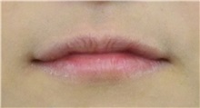 Lip Augmentation / Enhancement Before Photo by Richard Reish, MD, FACS; New York, NY - Case 32884