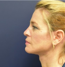Facelift After Photo by Richard Reish, MD, FACS; New York, NY - Case 32891