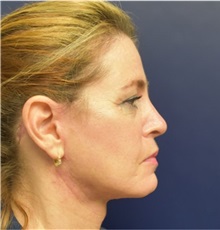 Facelift After Photo by Richard Reish, MD, FACS; New York, NY - Case 32891