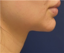 Chin Augmentation After Photo by Richard Reish, MD, FACS; New York, NY - Case 32896