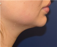Chin Augmentation Before Photo by Richard Reish, MD, FACS; New York, NY - Case 32896