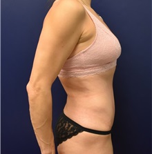 Tummy Tuck After Photo by Richard Reish, MD, FACS; New York, NY - Case 32925