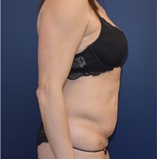 Tummy Tuck Before Photo by Richard Reish, MD, FACS; New York, NY - Case 32925