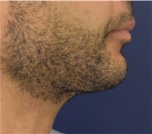 Chin Augmentation After Photo by Richard Reish, MD, FACS; New York, NY - Case 32930