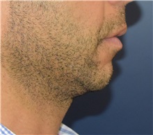 Chin Augmentation Before Photo by Richard Reish, MD, FACS; New York, NY - Case 32930