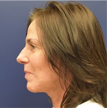 Facelift After Photo by Richard Reish, MD, FACS; New York, NY - Case 32933
