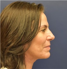 Facelift After Photo by Richard Reish, MD, FACS; New York, NY - Case 32933