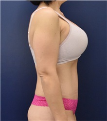 Tummy Tuck After Photo by Richard Reish, MD, FACS; New York, NY - Case 32936