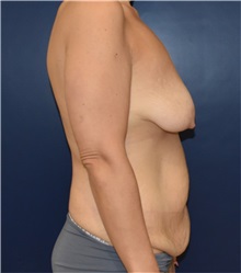 Tummy Tuck Before Photo by Richard Reish, MD, FACS; New York, NY - Case 32936