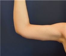 Arm Lift After Photo by Richard Reish, MD, FACS; New York, NY - Case 32940