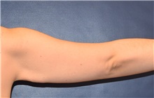 Arm Lift Before Photo by Richard Reish, MD, FACS; New York, NY - Case 32940