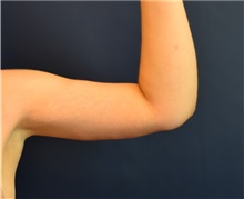 Arm Lift After Photo by Richard Reish, MD, FACS; New York, NY - Case 32940