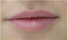 Lip Augmentation/Enhancement Before Photo by Richard Reish, MD, FACS; New York, NY - Case 32943