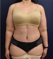 Tummy Tuck After Photo by Richard Reish, MD, FACS; New York, NY - Case 32944