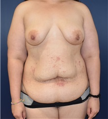 Tummy Tuck Before Photo by Richard Reish, MD, FACS; New York, NY - Case 32944