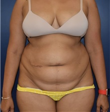 Tummy Tuck Before Photo by Richard Reish, MD, FACS; New York, NY - Case 33052