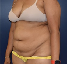 Tummy Tuck Before Photo by Richard Reish, MD, FACS; New York, NY - Case 33052