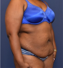 Tummy Tuck Before Photo by Richard Reish, MD, FACS; New York, NY - Case 33061