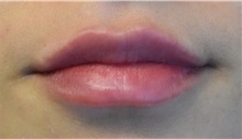 Lip Augmentation/Enhancement After Photo by Richard Reish, MD, FACS; New York, NY - Case 33062