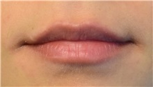 Lip Augmentation/Enhancement Before Photo by Richard Reish, MD, FACS; New York, NY - Case 33062