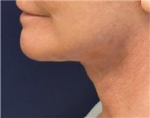 Facelift After Photo by Richard Reish, MD, FACS; New York, NY - Case 33071