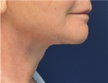 Facelift After Photo by Richard Reish, MD, FACS; New York, NY - Case 33071