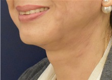 Facelift After Photo by Richard Reish, MD, FACS; New York, NY - Case 33189