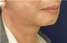 Facelift After Photo by Richard Reish, MD, FACS; New York, NY - Case 33189