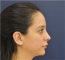 Chin Augmentation After Photo by Richard Reish, MD, FACS; New York, NY - Case 33194