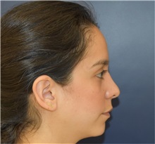 Chin Augmentation Before Photo by Richard Reish, MD, FACS; New York, NY - Case 33194