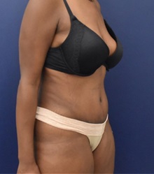 Tummy Tuck After Photo by Richard Reish, MD, FACS; New York, NY - Case 35289