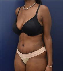 Liposuction After Photo by Richard Reish, MD, FACS; New York, NY - Case 35290