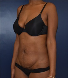 Liposuction Before Photo by Richard Reish, MD, FACS; New York, NY - Case 35290